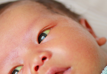 What to do if your baby has jaundice?